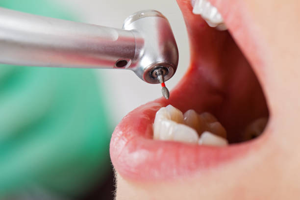 Best Emergency Dental Extractions in South Whitley, IN